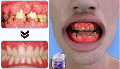 TEETHRESTORATION® (Polvo mineral para restauración dental)