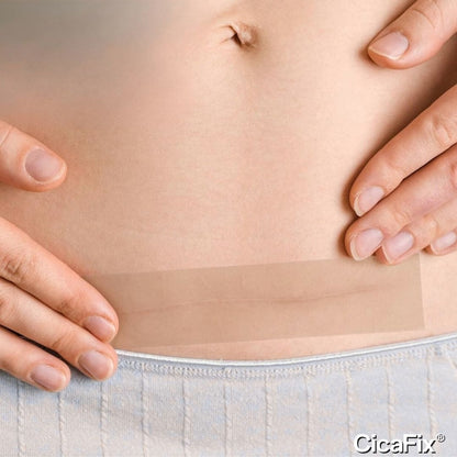 CicaFix® 2 X 1 (Parche Silicon Quita Cicatrices)