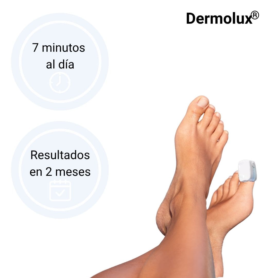 Dermolux® (Dispositivo láser para tratamiento de hongos en las uñas)