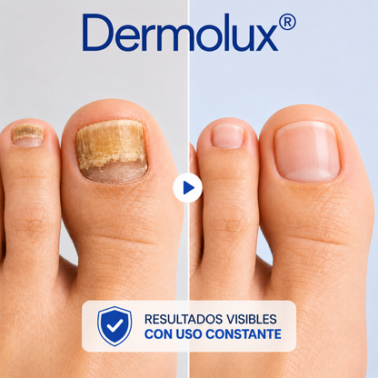 Dermolux® (Dispositivo láser para tratamiento de hongos en las uñas)