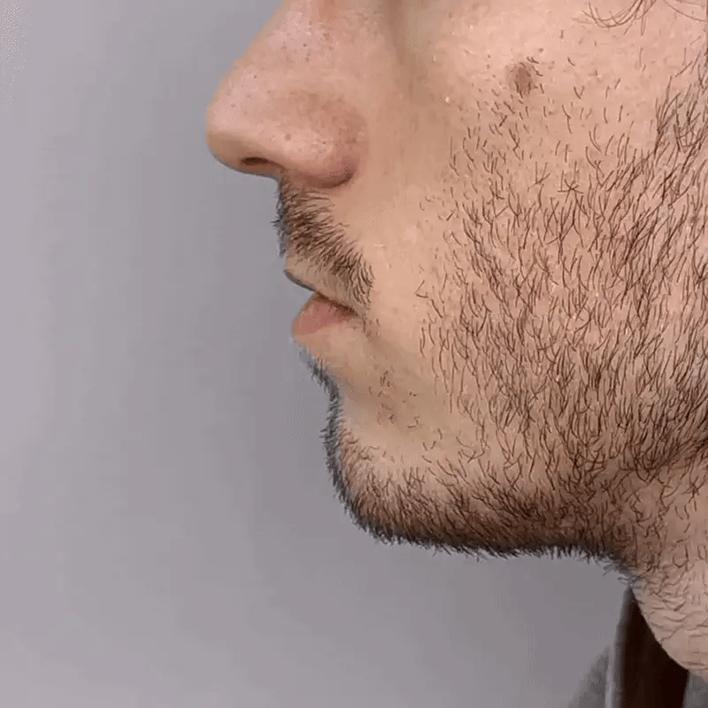 RespiLuz® (Dispositivo nasal)