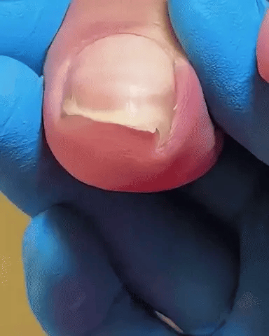 Podex® (Cortaúñas Biselado)
