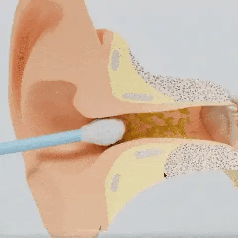 CeruClear® (Limpiador de Oídos Con Cámara Endoscopio)